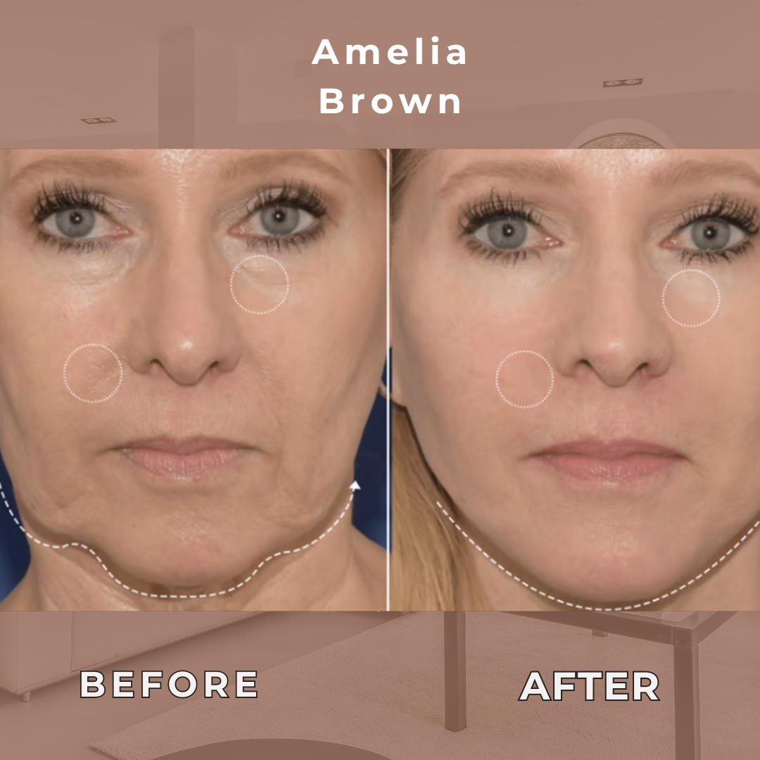 SilquéLift™ - Elevate Your Elegance — A Seamless Lift, Redefined.